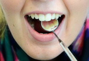 Kleiner Spiegel in einem Mund zum Untersuchen. Foto: Judith Wedderwille/Kreis Soest